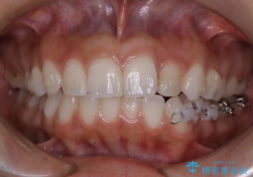 部分矯正とインビザラインを組み合わせて短期間での矯正治療の治療中