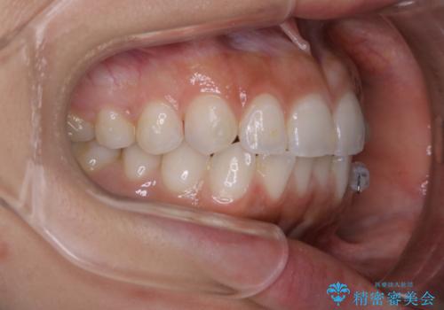 部分矯正とインビザラインを組み合わせて短期間での矯正治療の治療中