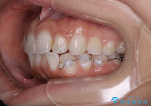 部分矯正とインビザラインを組み合わせて短期間での矯正治療の治療中