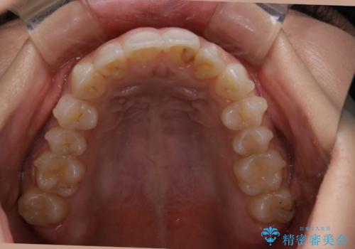 部分矯正とインビザラインを組み合わせて短期間での矯正治療の治療中