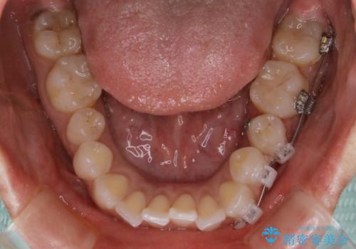 部分矯正とインビザラインを組み合わせて短期間での矯正治療の治療中