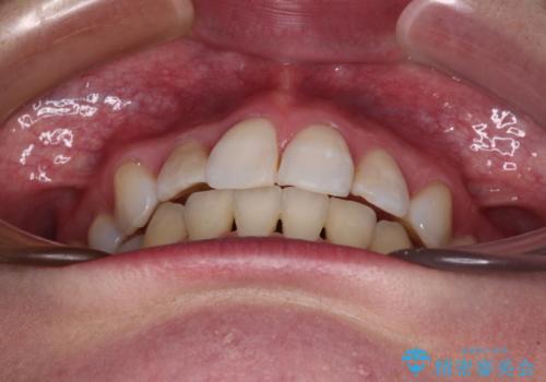 目立たないハーフリンガル矯正 抜歯矯正で口元を改善の治療後