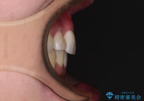 目立たないハーフリンガル矯正 抜歯矯正で口元を改善の治療後