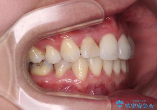 目立たないハーフリンガル矯正 抜歯矯正で口元を改善の治療後