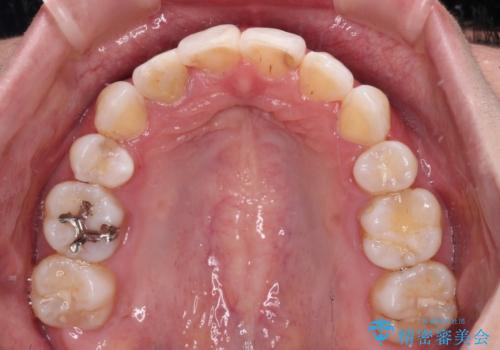目立たないハーフリンガル矯正 抜歯矯正で口元を改善の治療後
