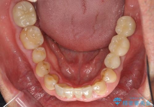 奥歯のインプラント 大人になって残っていた乳歯がダメになったの治療後