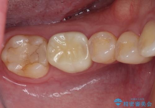 割れてしまったセラミッククラウン 強化セラミッククラウンの補綴治療の症例 治療後