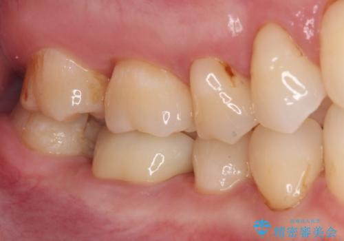 割れてしまったセラミッククラウン 強化セラミッククラウンの補綴治療の治療後