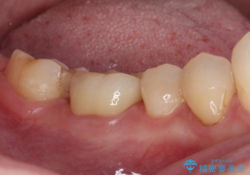 割れてしまったセラミッククラウン 強化セラミッククラウンの補綴治療