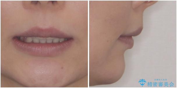 インビザラインが続けられない ワイヤー装置による抜歯矯正の治療後(顔貌)