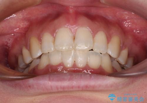 インビザラインが続けられない ワイヤー装置による抜歯矯正の治療後