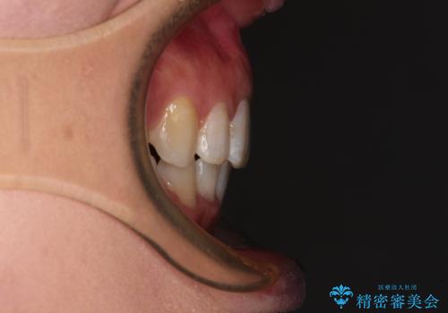 インビザラインが続けられない ワイヤー装置による抜歯矯正の治療後