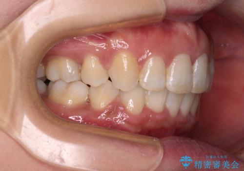 インビザラインが続けられない ワイヤー装置による抜歯矯正の治療後