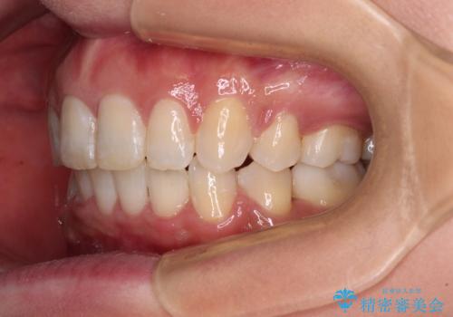 インビザラインが続けられない ワイヤー装置による抜歯矯正の治療後