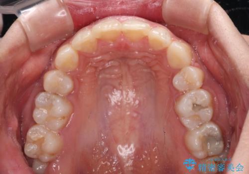 インビザラインが続けられない ワイヤー装置による抜歯矯正の治療後