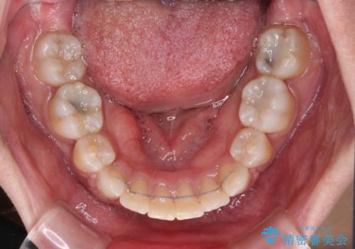 インビザラインが続けられない ワイヤー装置による抜歯矯正の治療後