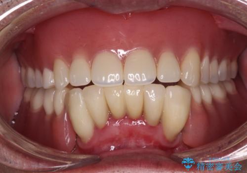 どこで咬んでいいのか分からない インプラント・オーバーデンチャーによる補綴治療の症例 治療後