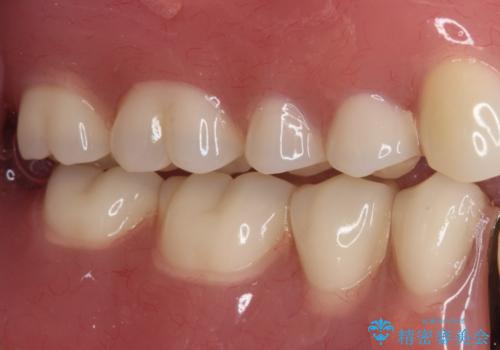 どこで咬んでいいのか分からない インプラント・オーバーデンチャーによる補綴治療の治療後