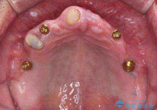 どこで咬んでいいのか分からない インプラント・オーバーデンチャーによる補綴治療の治療後