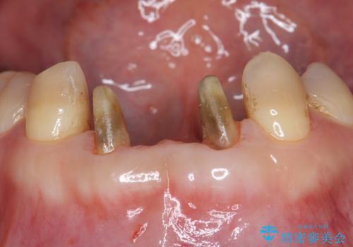 下の前歯のブリッジ 保険治療のやり替えの治療中