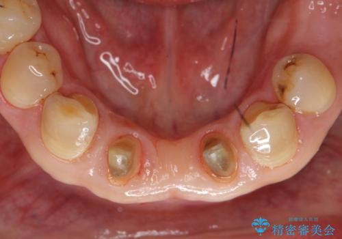 下の前歯のブリッジ 保険治療のやり替えの治療中