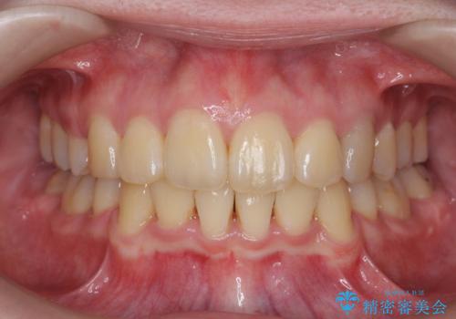 20代女性　前から5番目の歯を抜歯の症例 治療後