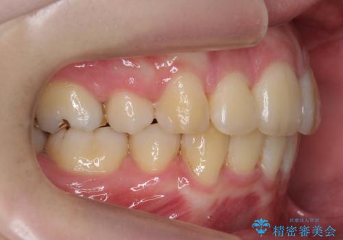 20代女性 前から5番目の歯を抜歯の治療後