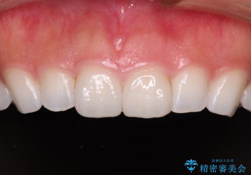 前歯の形を変えたい　前歯のラミネートベニア治療の症例 治療後