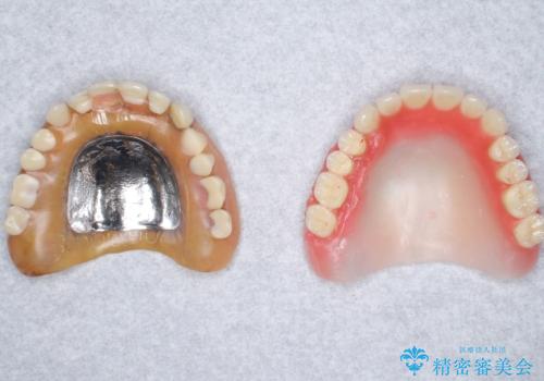 上の入れ歯がゆるくてはずれやすい 適合の良い金属床義歯 70代女性の治療中