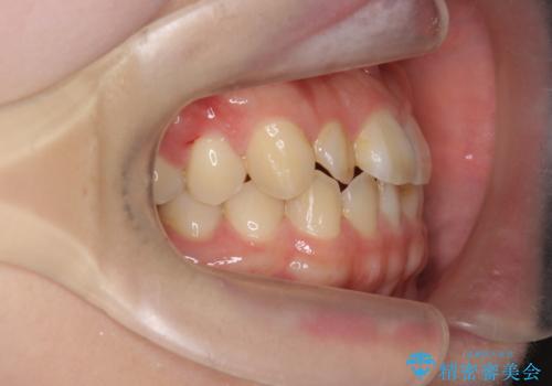 [ マウスピース矯正 ]  前歯のねじれを治したいの治療前
