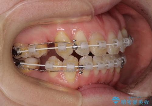 抜歯矯正で閉じにくかった口を閉じやすく改善の治療中