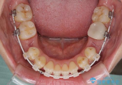 抜歯矯正で閉じにくかった口を閉じやすく改善の治療中
