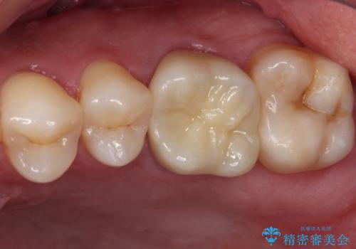 耳鼻科で指摘されたむし歯 根管治療とセラミッククラウンの症例 治療後