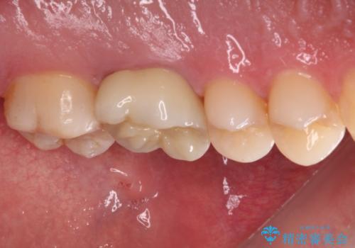 耳鼻科で指摘されたむし歯 根管治療とセラミッククラウンの治療後
