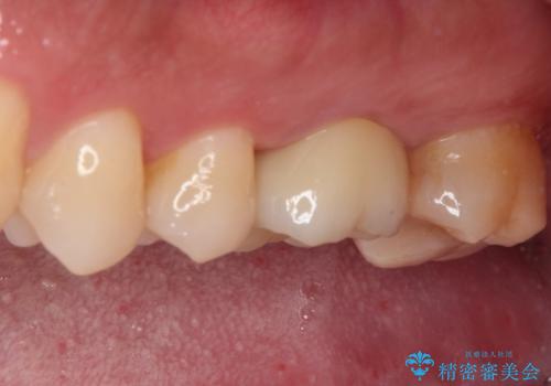 耳鼻科で指摘されたむし歯 根管治療とセラミッククラウンの治療後