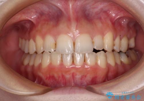 顕著な八重歯をインビザラインで治せるところまで改善の治療後