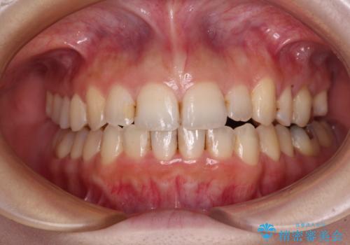 顕著な八重歯をインビザラインで治せるところまで改善
