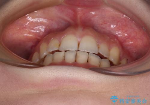 顕著な八重歯をインビザラインで治せるところまで改善の治療後