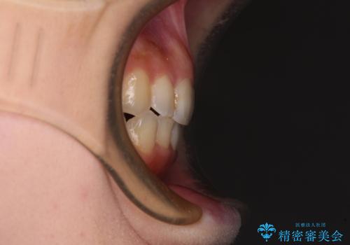 顕著な八重歯をインビザラインで治せるところまで改善の治療後