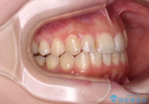 顕著な八重歯をインビザラインで治せるところまで改善の治療後