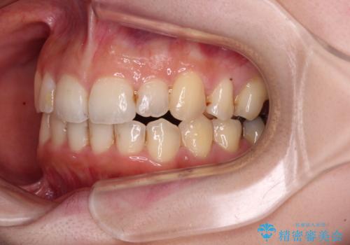 顕著な八重歯をインビザラインで治せるところまで改善の治療後