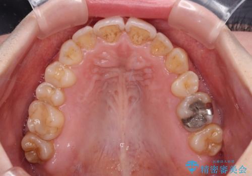 顕著な八重歯をインビザラインで治せるところまで改善の治療後