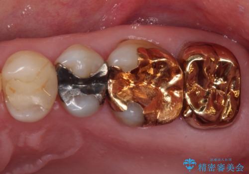 奥歯が外れた　ゴールドクラウンによる補綴治療
