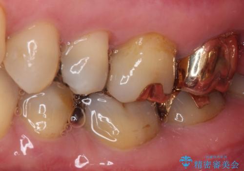 奥歯が外れた ゴールドクラウンによる補綴治療の治療後