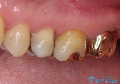 奥歯が外れた ゴールドクラウンによる補綴治療の治療後