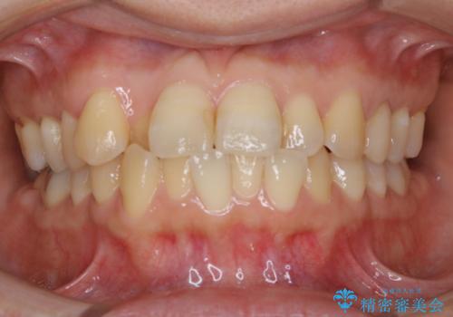 インビザラインで前歯の中心をお顔の中心に合わせるの症例 治療前