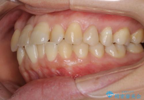 インビザラインで前歯の中心をお顔の中心に合わせるの治療前