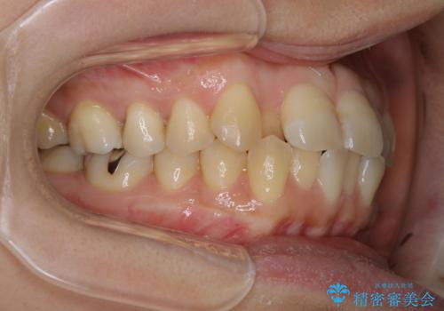 インビザラインで前歯の中心をお顔の中心に合わせるの治療前