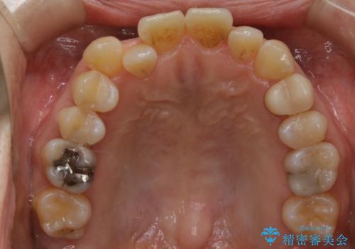 インビザラインで前歯の中心をお顔の中心に合わせるの治療前