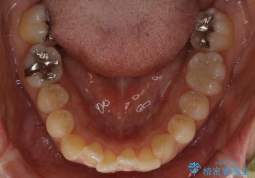 インビザラインで前歯の中心をお顔の中心に合わせるの治療前